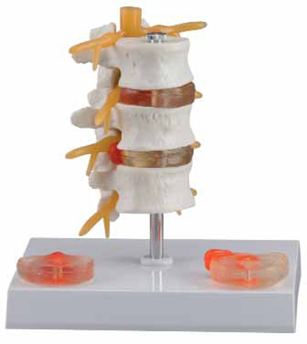 3 Lumbar Vertebrae with Hernia and Prolapsed Intervertebral Disc